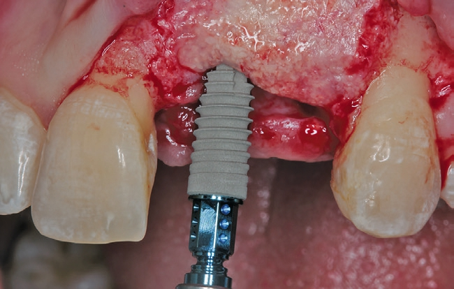 Abb. 16a: Implantation regio 21.