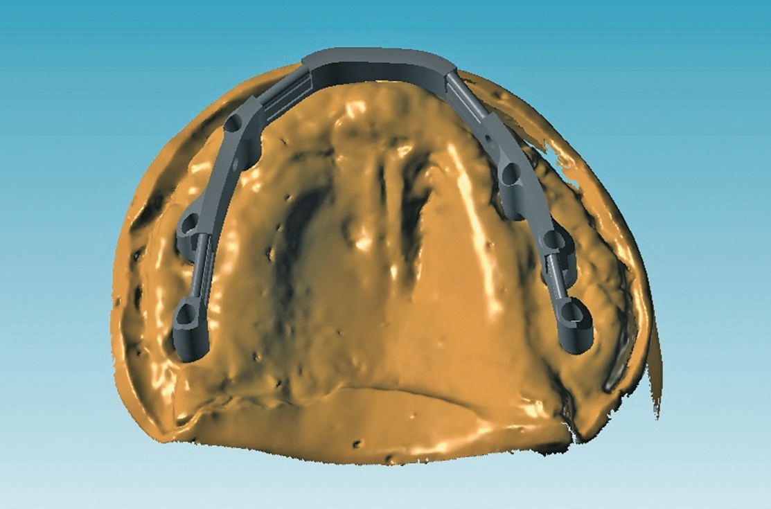 Abb. 15: Digitale Planung der Stegkonstruktion (ISUS/Atlantis Dentsply Sirona).
