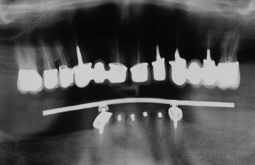 Abb. 15: Die Röntgenkontrolle ermöglicht auch, Zementüberschüsse zu erkennen. (Anm.: Weitere notwendige Therapiemaßnahmen im Gebiss werden an dieser Stelle nicht besprochen).