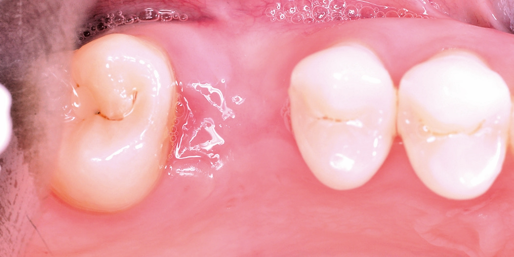 Abb. 16: Situation drei Monate nach Implantatinsertion.