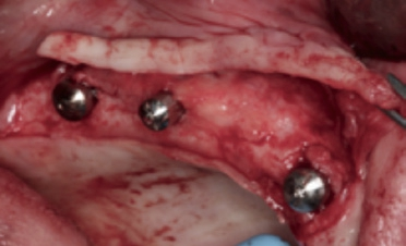 Abb. 16: Der apikale Verschiebelappen zur Rekonstruktion der mukogingivalen Grenze.