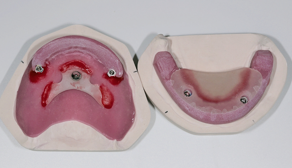 Abb. 16: Gerber-Zentrikregistrat zur sicheren Fixierung auf jeweils zwei Implantaten fixiert.