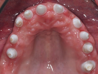 Abb. 18: 5 Monate post OP ist das periimplantäre Gewebe gut abgeheilt, konsolidiert und entzündungsfrei.