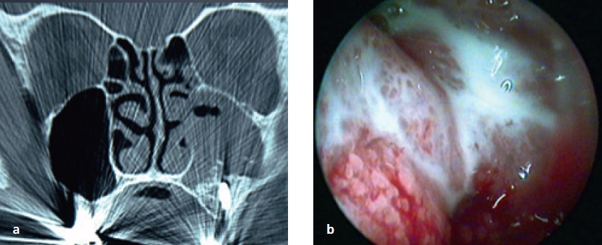 Abb. 14a u. b: a) Linksseitige akute Sinusitis maxillaris. Zustand 4 Monate nach dentaler Implantation mit Sinuslift. b) Endoskopisches Bild dieser KH links. Auf einer entzündlich verdickten Schleimhaut ist eitriges Sekret als Ausdruck der purulenten Infektion erkennbar.