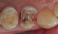 Abb. 16: Die nach Exkavation okklusal sehr tiefe, aber bis auf eine Stelle mesial nahezu komplett schmelzbegrenzte Kavität. Im Bereich des Dentins des palatinalen Höckers imponiert eine Infraktionslinie.