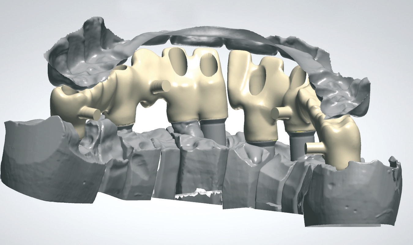 Abb. 16: Nach Modellherstellung CAD/CAM generierte Zirkongerüste – linguale Ansicht.