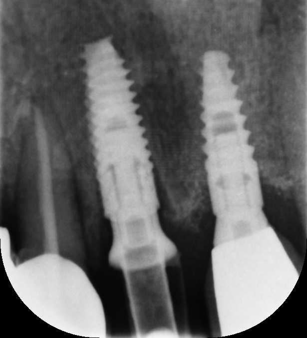 Abb. 14: Röntgen postoperativ.