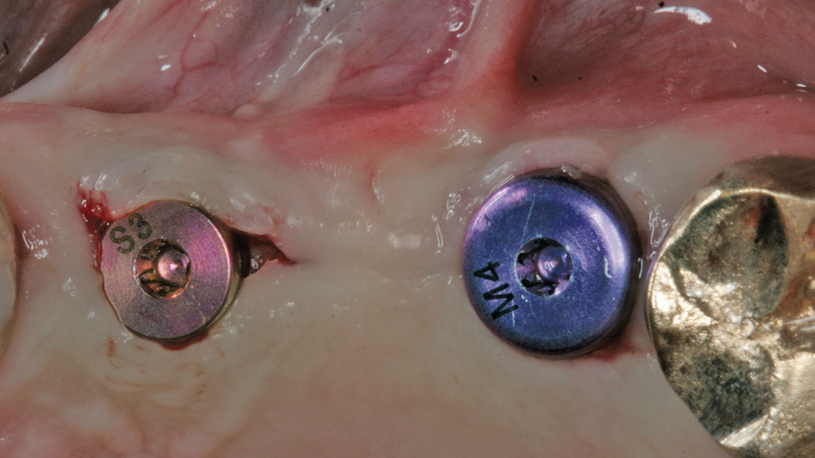 Abb. 16: Freilegung der Implantate mit Verlagerung der Schleimhaut nach vestibulär.