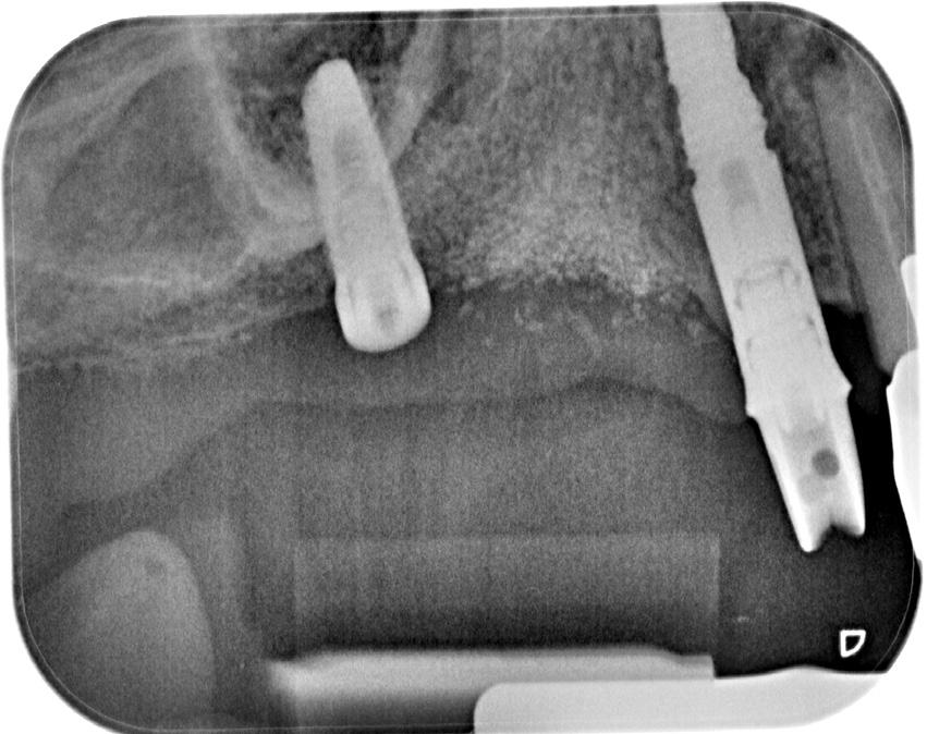 Abb. 16: Röntgenaufnahme zeigt die Osseointegration des Implantates nach vier Monaten.