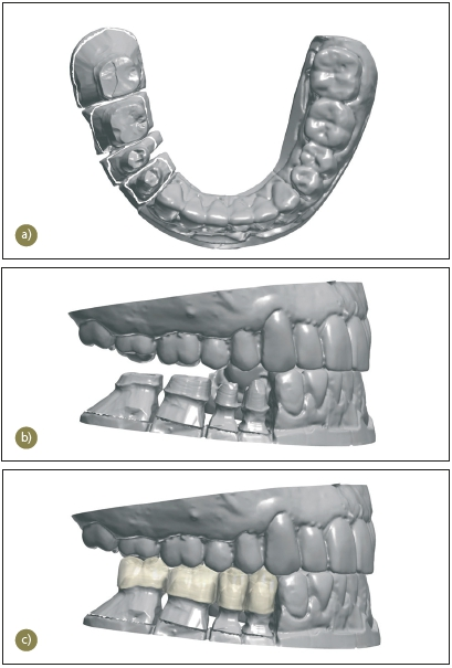 Abb. 16: 3D-Scan des Unterkiefermodells nach Präparation der Zähne auf der rechten Seite. a) Modellaufsicht. b) Zuordnung der Modelle nach Bissnahme. c) Konstruktion der monolithischen Zirkoniumdioxidkronen.