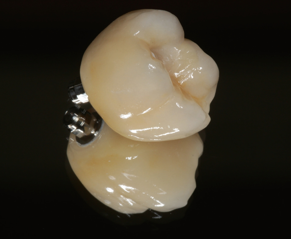 Abb. 17: Fertige Restauration.