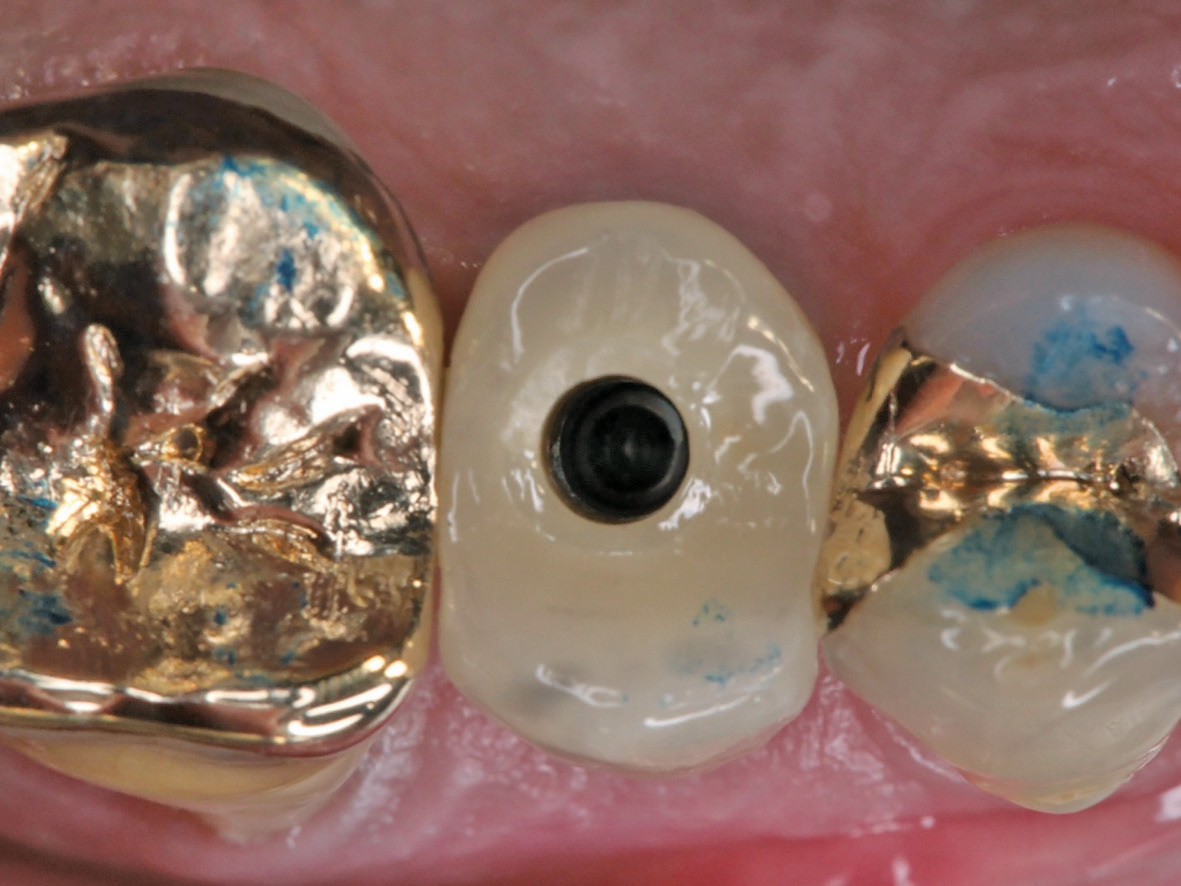 Abb. 19: Implantatkrone in situ. Auf Wunsch des Patienten erfolgte zusätzlich eine Verschraubung.