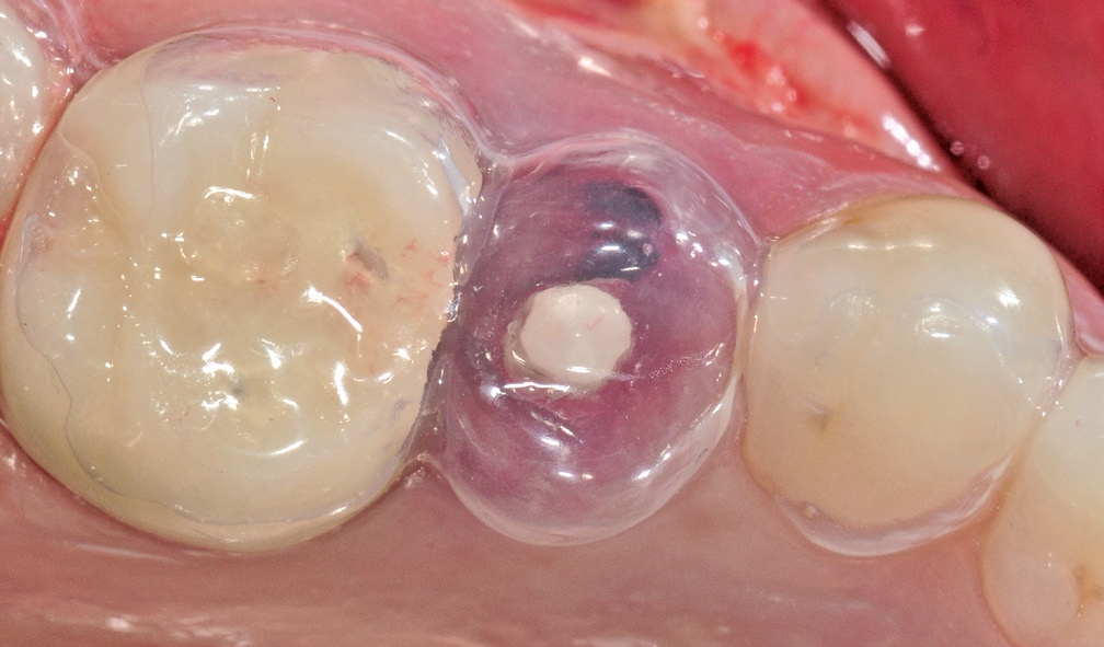 Abb. 16: Mit einer zuvor angefertigten Tiefziehschiene konnte eine provisorische Krone intraoral erstellt werden.