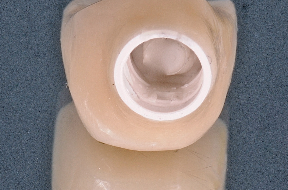 Abb. 19: Fertiges Provisorium von basal.