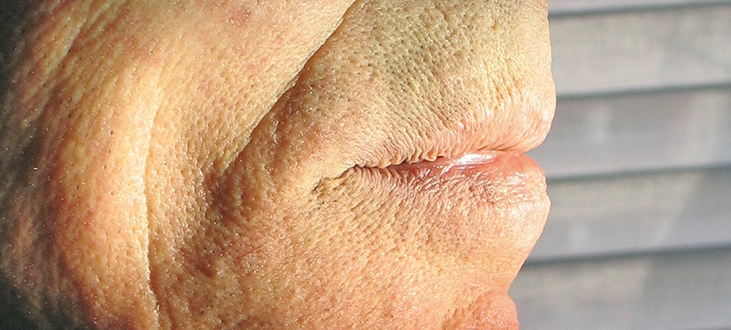 Abb. 15: Patientin seitlich mit optimaler Unterstützung der Weichgewebe.