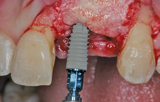 Abb. 16a: Implantation regio 21.