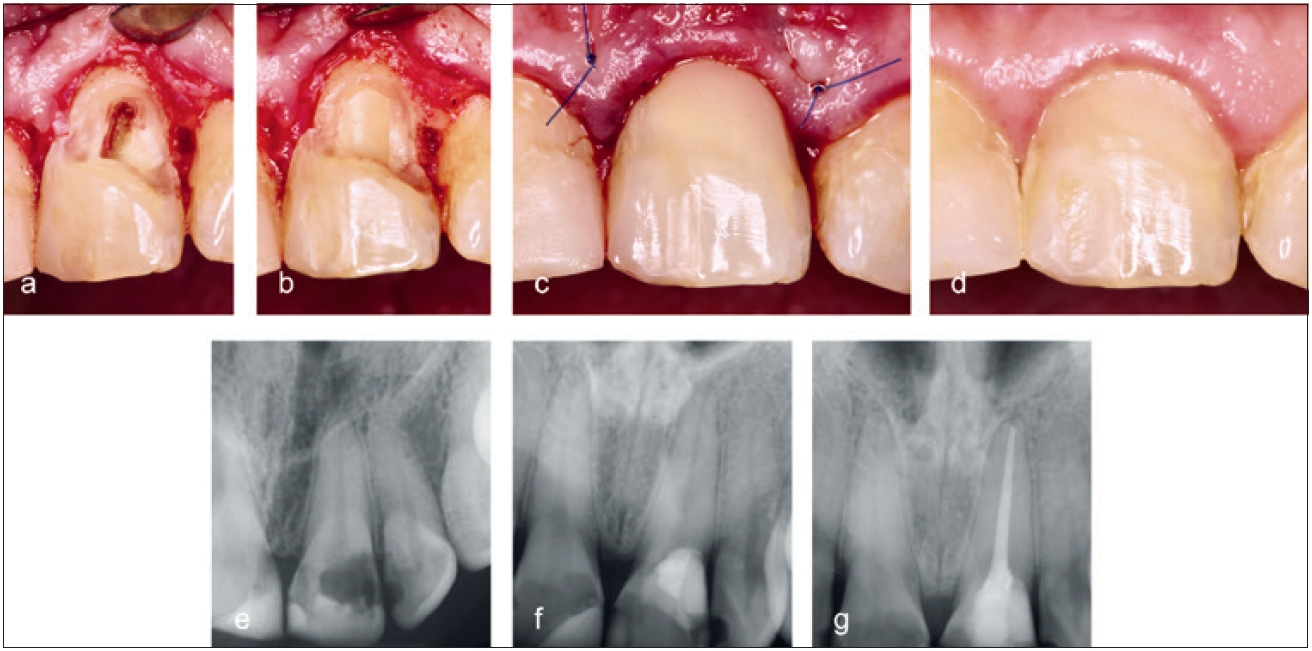 Abb. 15a: Ausgedehnte invasive zervikale Resorption am Zahn 21 mit Pulpabeteiligung. b: Entfernung des Granulationsgewebes und Abdeckung des Pulpakavums. c: Wundverschluss. d: Klinischer Zustand nach 6 Wochen. e: Präoperatives Röntgenbild. f: Postoperatives Röntgenbild. g: Radiologischer Zustand mit Wurzelfüllung nach 6 Wochen.