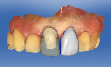 Abb. 18: Desing der Kronen mit der CEREC-Software 4.6.1.