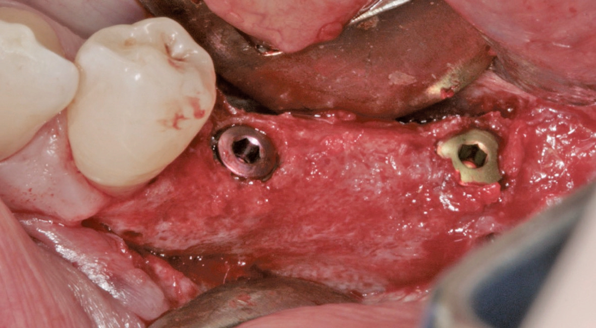 Abb. 17: Die Insertion von zwei Implantaten im Unterkiefer links.