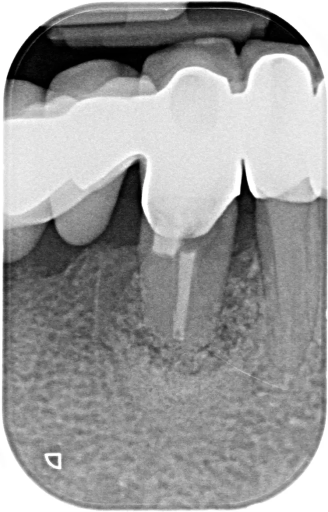 Abb. 16: Röntgenologisch ist im Bereich der aufgefüllten Stelle eine Konsolidierung mit Knochenregeneration nach 3 und 12 Monaten zu erkennen.