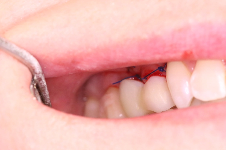Abb. 17: Provisorische Versorgung der Implantate.