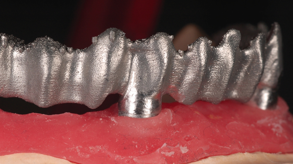 Abb. 18: Gute Passform des SLM gefertigten Kobalt-Chrom Gerüsts.