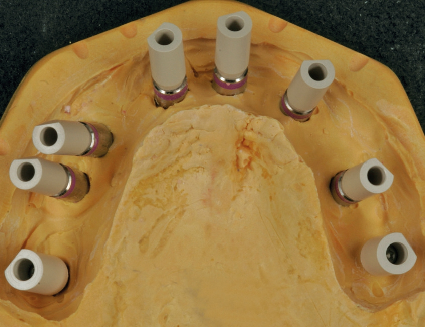 Abb. 17: In die Manipulierimplantate eingeschraubte Scanbodies zur Digitalisierung des Meistermodells.
