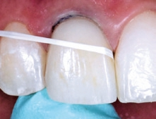 Abb. 17: Nach der Positionierung des Veneers werden die Überschüsse interdental mit einer breiten Teflonzahnseide entfernt.