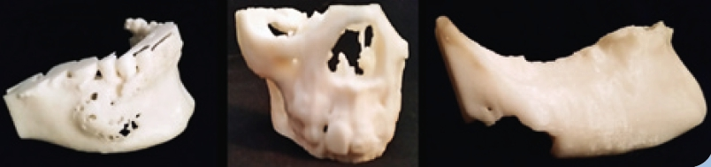 Abb. 25: DVT – datenbasierte Ausdrucke von Biomodellen: Granuloma gigantocellulare, Osteom, Metastase eines Mammakarzinoms.