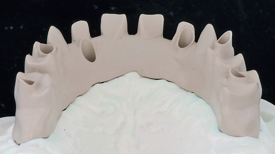 Abb. 16: Neue maschinell verarbeitbare Materialien bringen neue Eigenschaften, wie PEEK, PEKK oder Pekkton, sie müssen sich aber noch langfristig bewähren.