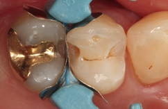 Abb. 17: Die exkavierten und mit FACE-Light-Kontrolle als kariesfrei eingestuften Kavitäten, bereits mit Teilmatrizen und einem Spannring isoliert.