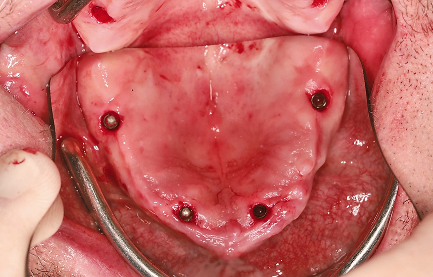 Abb. 17: Klinische Situation der inserierten Implantate im Oberkiefer.