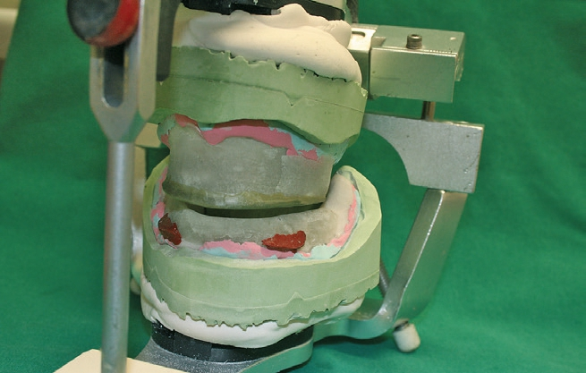 Abb. 12: Im Artikulator wird die zentrische Bissnahme vorbereitet.