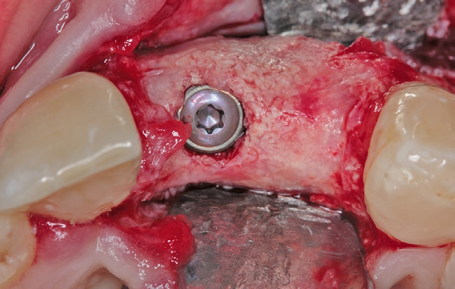 Abb. 16b: Das Implantat in korrekter Position.