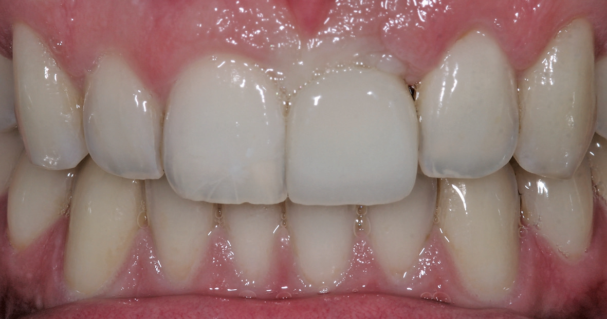 Abb. 15: Nach der Implantatfreilegung wurde im Labor eine provisorische Implantatkrone aus PMMA konstruiert, um die Gingiva zu formen.