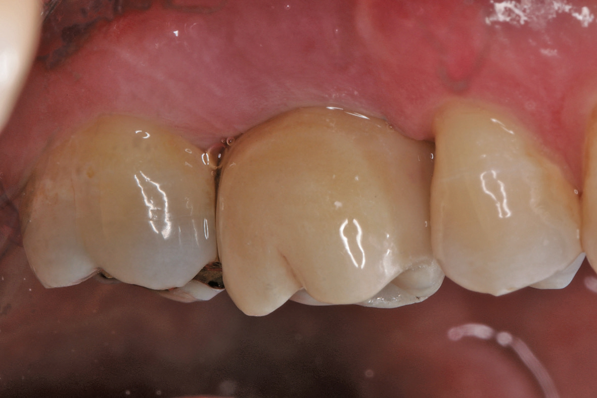 Abb. 17: Eingliederte Abutmentkrone mit Gestaltung des periimplantären Sulcus durch Zirkonoxidkeramik.