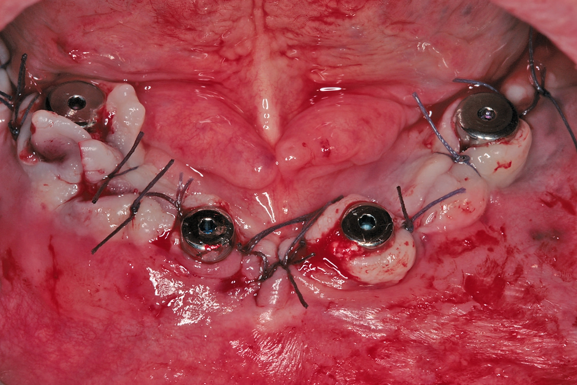 Abb. 15: Spannungsfreie Naht zur offenen Einheilung der Implantate im Unterkiefer.
