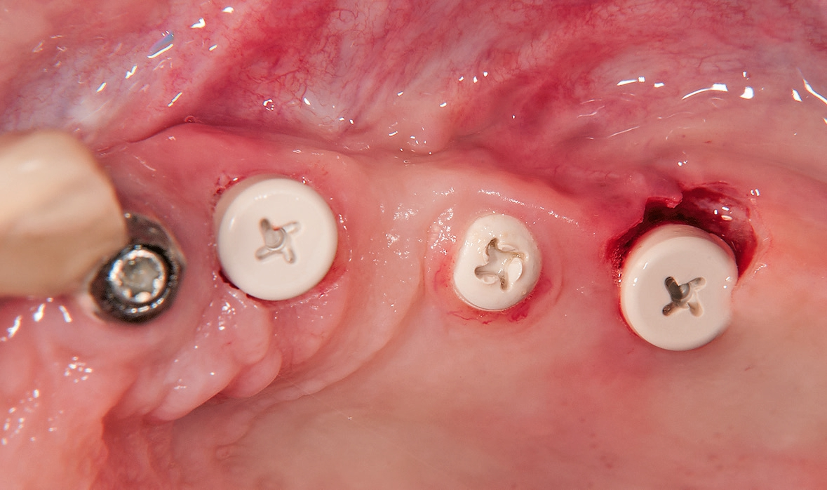 Abb. 17: Nach der Abformung Verschluss der Implantate mit Healingcap und Gingivaformer.
