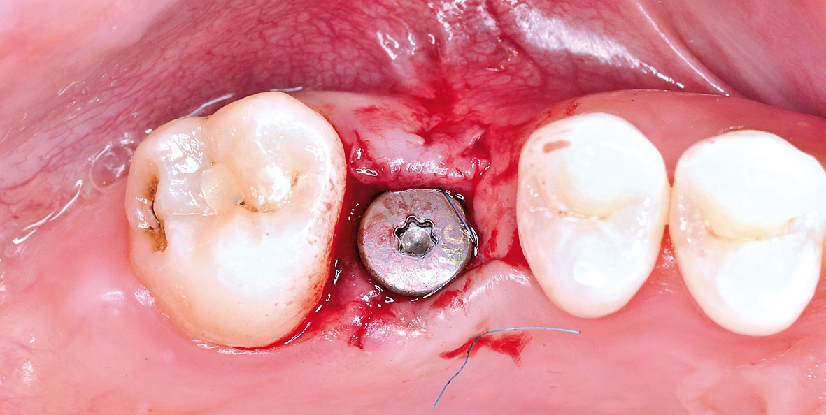 Abb. 17: Einbringen der Einheilkappe nach Freilegung des Implantats.