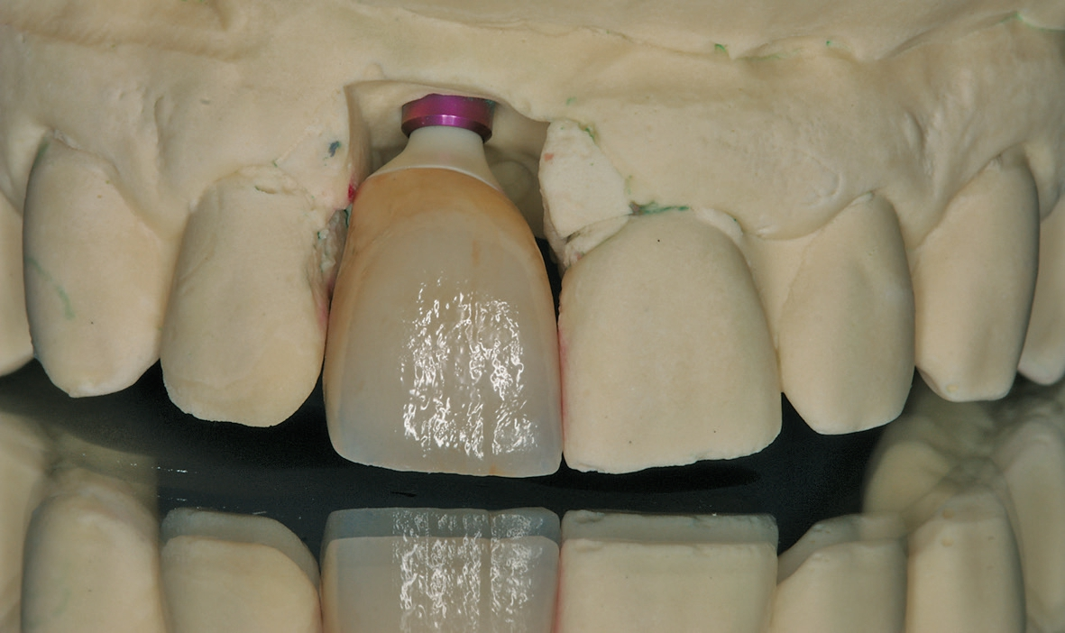 Abb. 18: Das fertige Gerüst wurde ans Dentallabor zurückgeschickt und die Krone mit Verblendkeramik fertig gestellt.