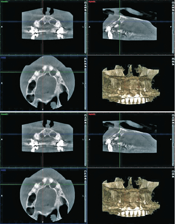 Abb. 17 a und b: Diagnostisches DVT präoperativ Fall 2; raumfordernde zystische Ausdehnung regio 12 (a) und 22 apikal (b).