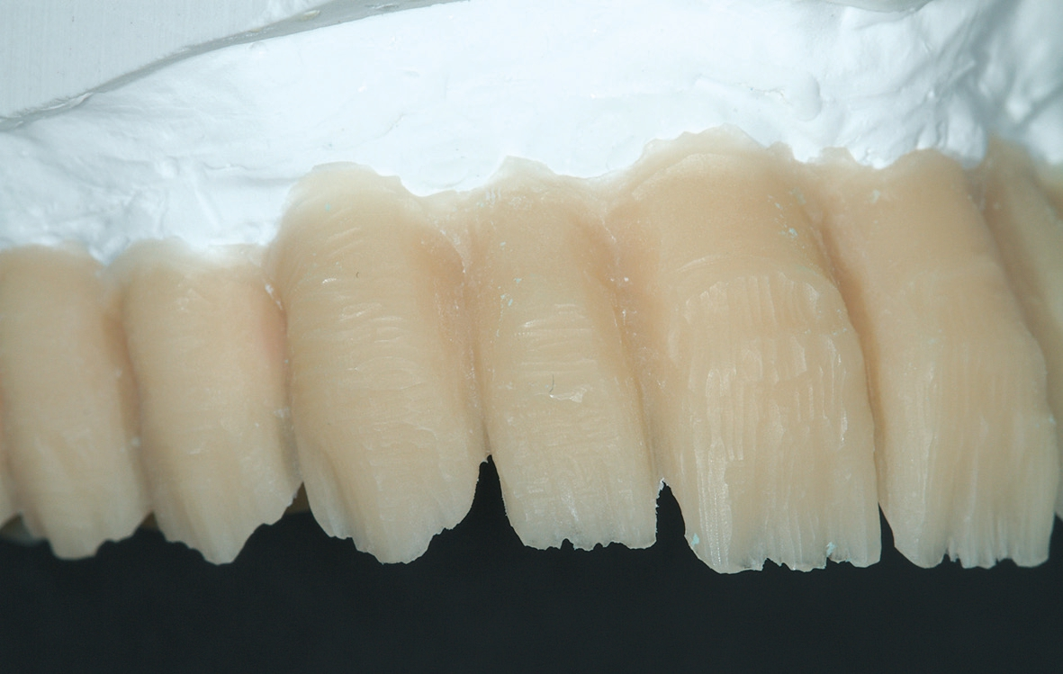 Abb. 17: Konstruktion des Oberkiefer-Langzeitprovisoriums; hier: Cutback des Dentinkerns.