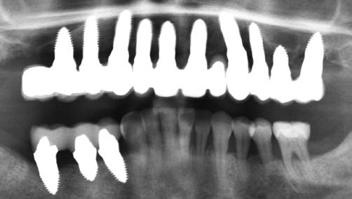 Abb. 19: Vollkommen metallfreie finale Versorgung des OK mit 3 Keramikbrücken sowie 3 verblockten e.-max-Kronen chairside im 4. Quadranten.