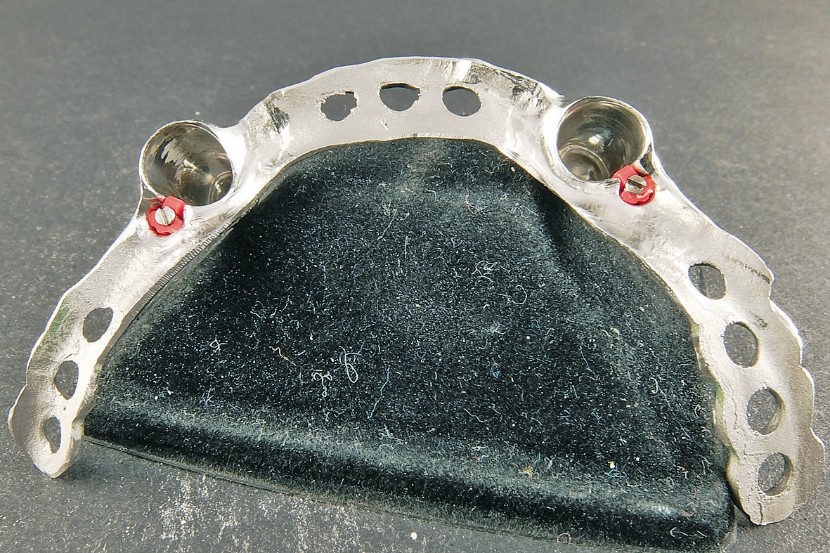 Abb. 84: Im Unterkiefer wurde im Einstückgussverfahren die edelmetallfreie Sekundärkonstruktion (Brealloy F 400, bredent) hergestellt. Dieses Material kann grazil gestaltet werden und bietet die notwendige Stabilität. Zusätzlich wurden Friktionshilfen zur Feinjustierung eingearbeitet.
