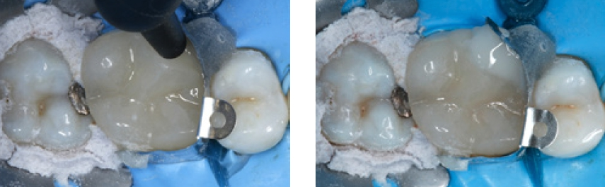 Abb. 18 und 19: Das restliche Defektvolumen wird mit seitenzahntauglichem normalviskösem Ormocerkomposit aufgefüllt und damit der mesiopalatinale Höcker wieder komplettiert.