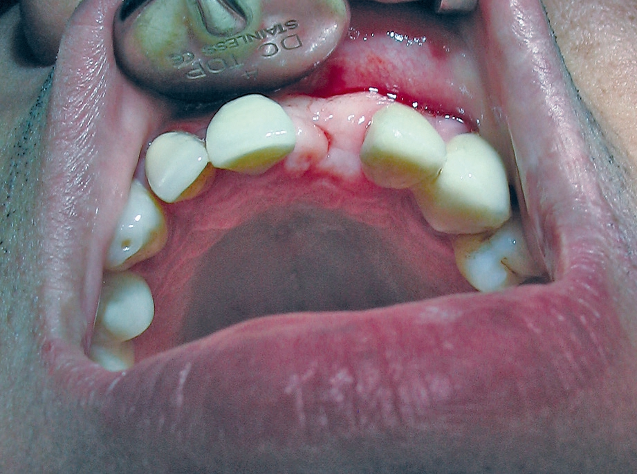 Abb. 15: Klinische Situation vor der zweiten Implantation.