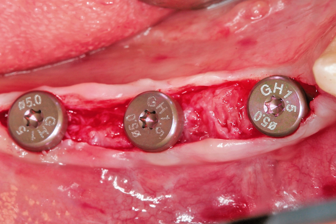 Abb. 19: In die Implantate wurden RB/WB Gingivaformer eingesetzt…