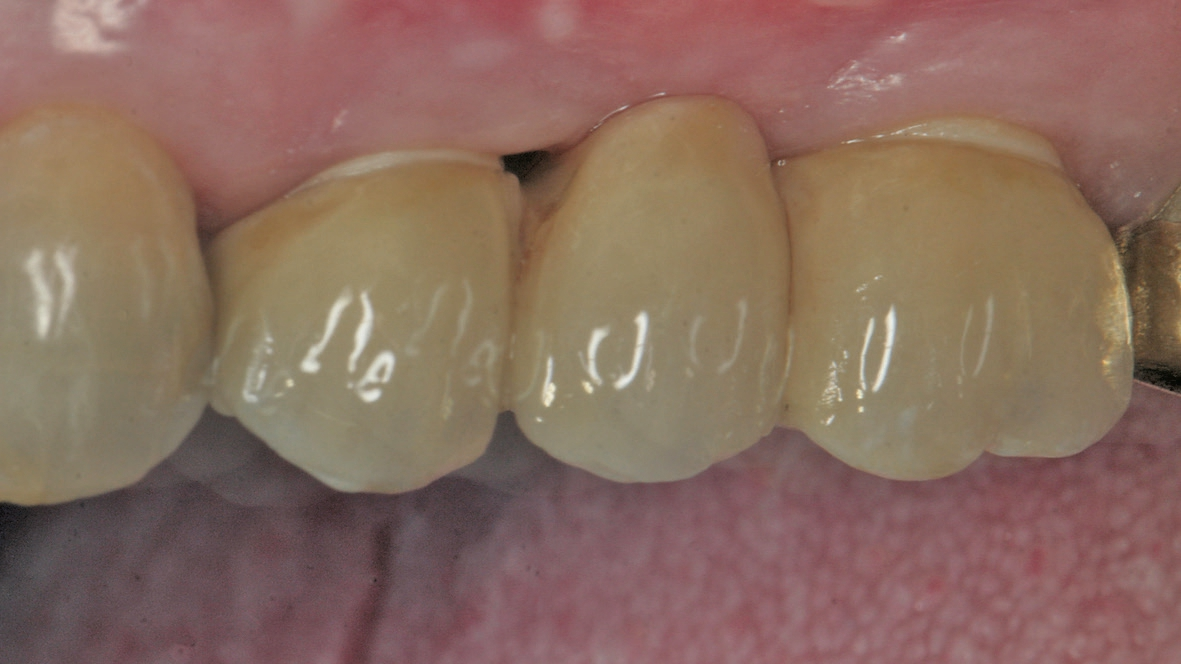Abb. 17: Dreigliedrige Brücke auf zwei Implantaten