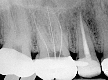 Abb. 16: Kontrollaufnahme 6 Monate später: der Zahn 15 apikal ist ausgeheilt und Puff ist resorbiert.