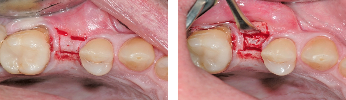 Abb. 16a und b: Behutsames Freilegen des Implantates. Das Implantat ist völlig mit Knochen bedeckt.